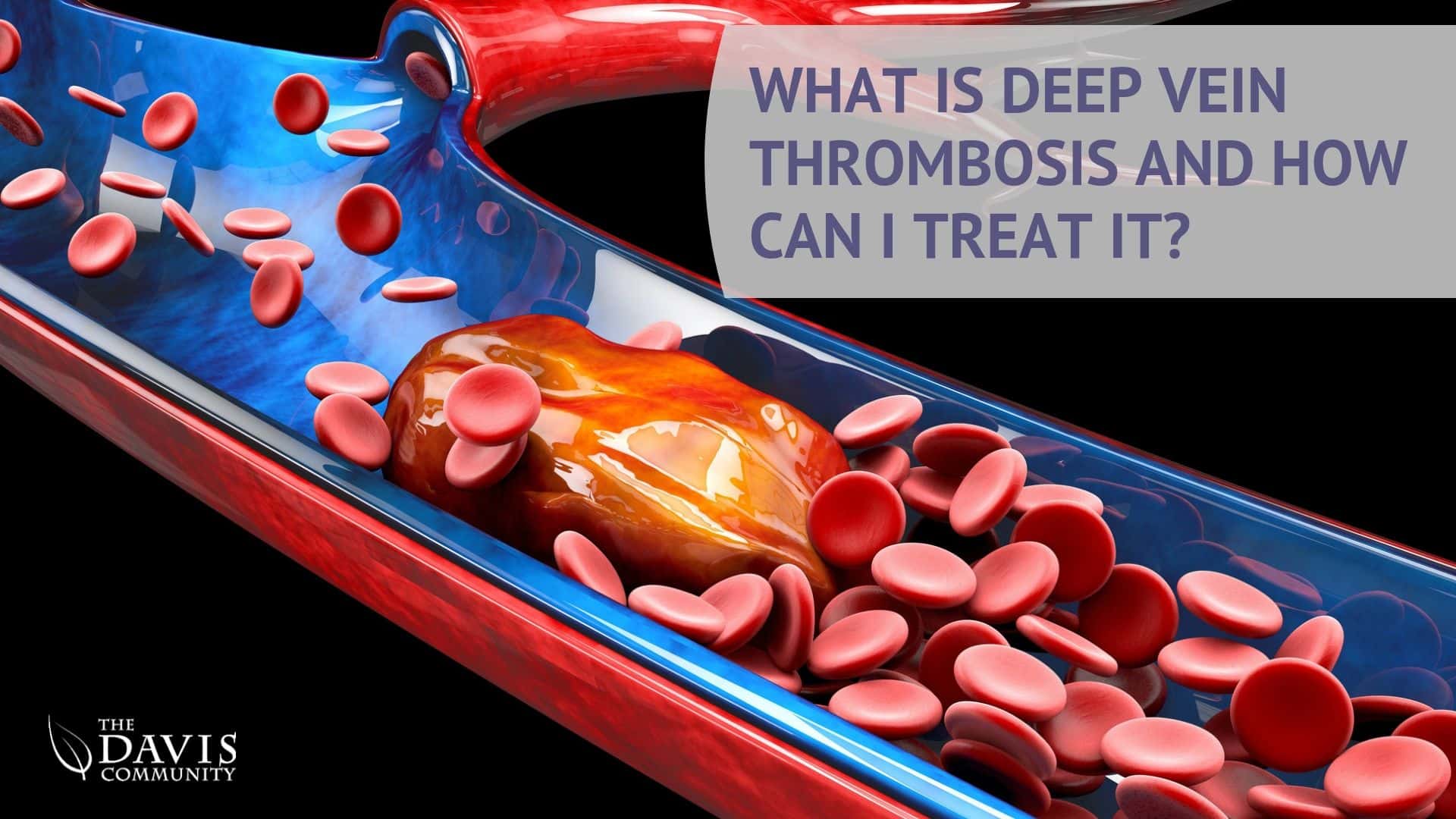 deep vein thrombosis definition